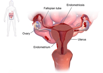 PCOD and Endometriosis